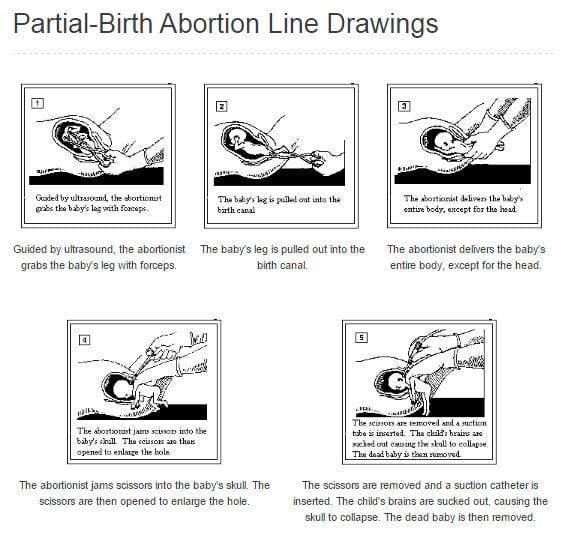 partial-birth-abortion-diagram