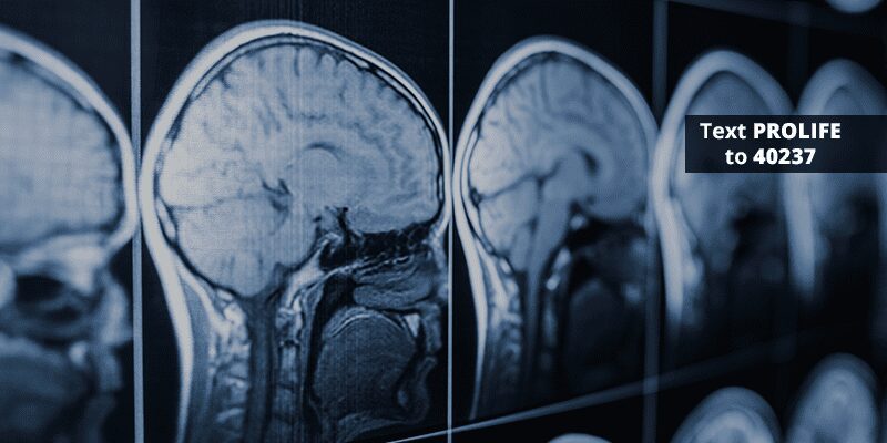 New Neurology Research Encourages Long Recovery for Brain Injury Patients
